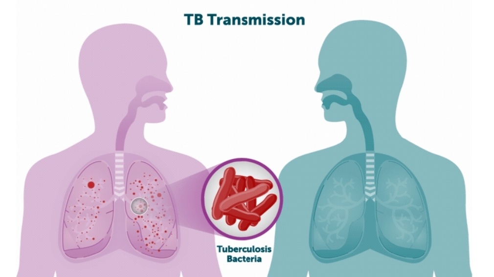 बिहार में टीबी मरीजों की बढ़ती संख्या, गरीबी और कुपोषण बने सबसे बड़े कारण