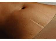 “नाभि थेरेपी” के चमत्कारी दावों पर फिर चर्चा तेज — जानिए क्या है पूरा सच